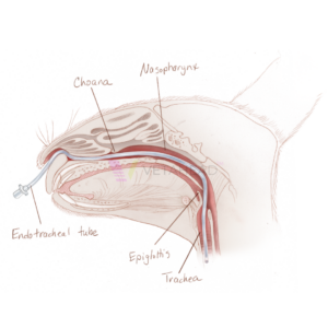 Nasotracheal intubation